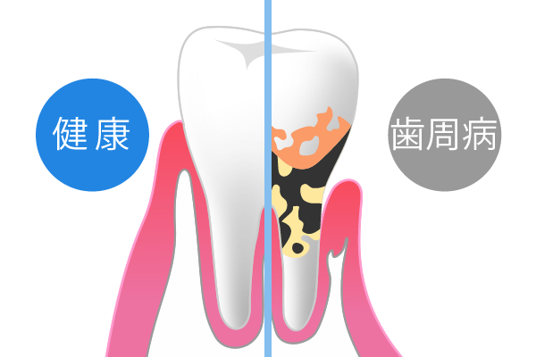 歯周病とは